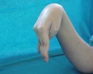 Pokus o zvednutí zápěstí a prstů před operací